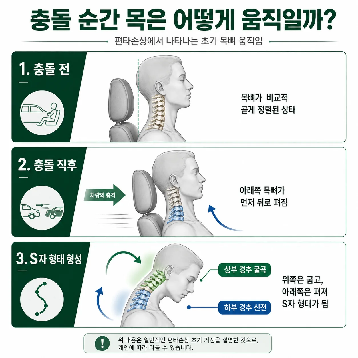 가속-감속 충격에서 목뼈가 S자로 움직이는 기전