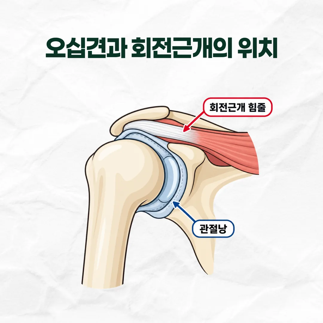 오십견 관절낭과 회전근개 위치를 비교한 어깨 단면 개념도