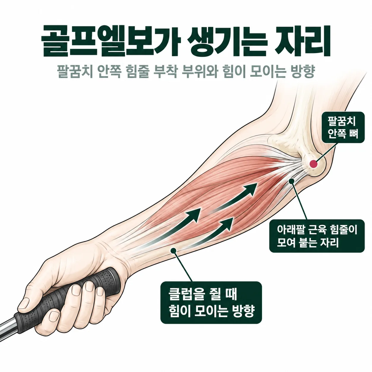 골프엘보가 생기는 팔꿈치 안쪽 힘줄 부착 자리와 힘이 모이는 방향 개념도
