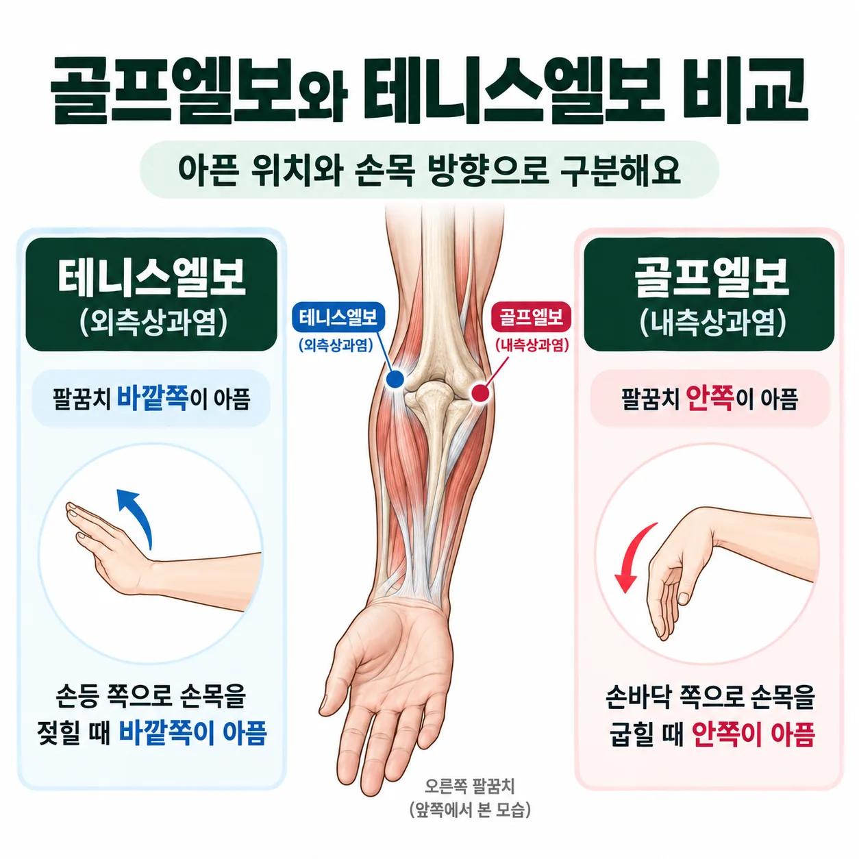 골프엘보와 테니스엘보의 아픈 위치와 손목 방향을 비교한 팔꿈치 그림