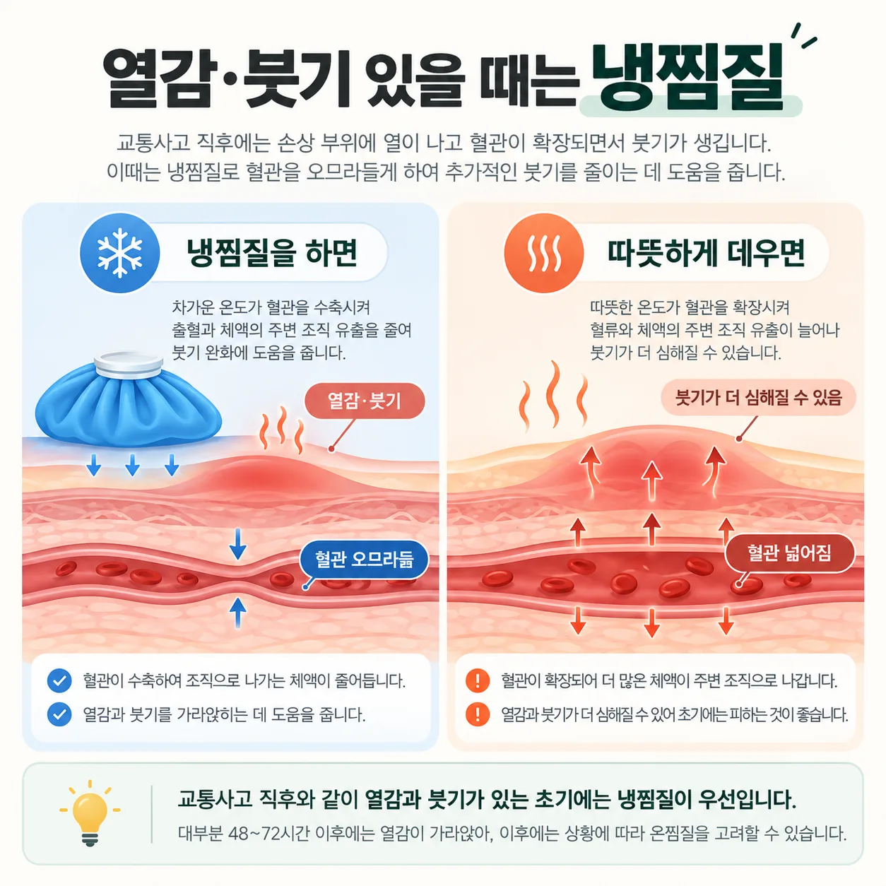 교통사고 직후 열감과 붓기가 있을 때 차가운 찜질을 쓰는 이유를 혈관 굵기로 보여 주는 단면도